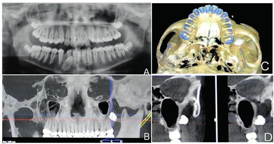 INTRODUÇÃO O deslocamento acidental de fragmentos e/ou de dentes para espaços fasciais é uma das complicações associadas à exodontia de terceiros molares.