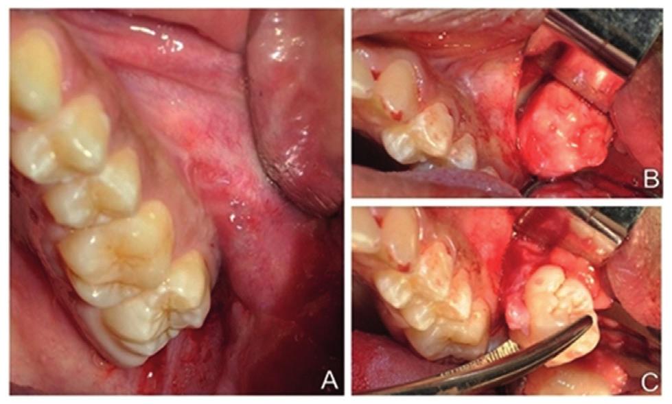 Figura 2 - A: Aspecto clínico inicial não mostra qualquer elevação na região da mucosa bucal; B: Cápsula fibrosa envolvendo o dente deslocado; C: Remoção do germe dentário do espaço bucal.