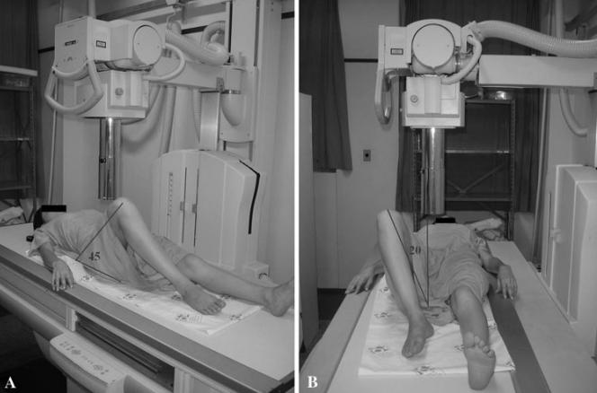 The Dunn 45 view was obtained with the patient su pine with the hip to be X-rayed at 45 flexion and 20 of abduction in neutral rotation, with the X-ray tube directed at the inguinal crease,