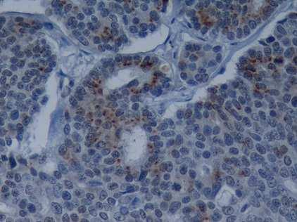 Vinte e nove neoplasias evidenciaram imunomarcação positiva para o anticorpo CLDN-2 na componente epitelial luminal.