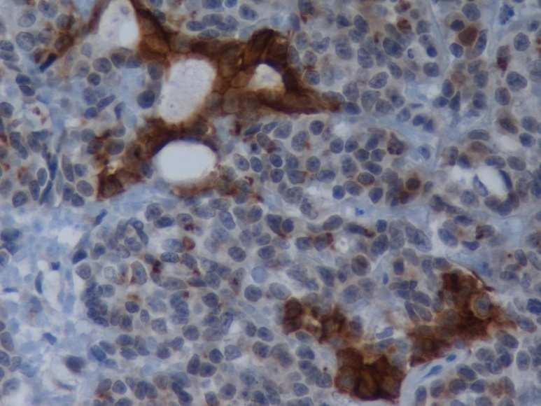 Figura 10: Carcinoma sólido com áreas de produção de mucina (400x). Marcação membranar e citoplasmática densa, forte nas células epiteliais luminais.