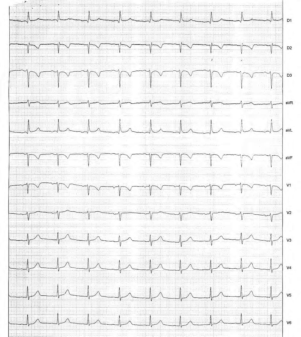 Figura 1 - Paciente DV, ECG prévio ao BAV avançado Bloqueio divisional ântero-superior esquerdo.