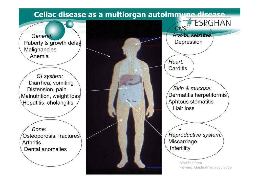 8. Anexos Anexo 1 Doença Celíaca como doença auto-imune sistémica multiorgânica in HUSBY, S., KOLETZKO, S., KORPONAY-SZABÓ, I.R., MEARIN, M.L., PHILLIPS, A. et al.