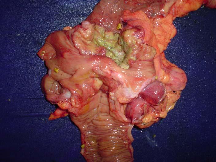 Resultados 22 Tumor no ângulo hepático Cálculos biliares