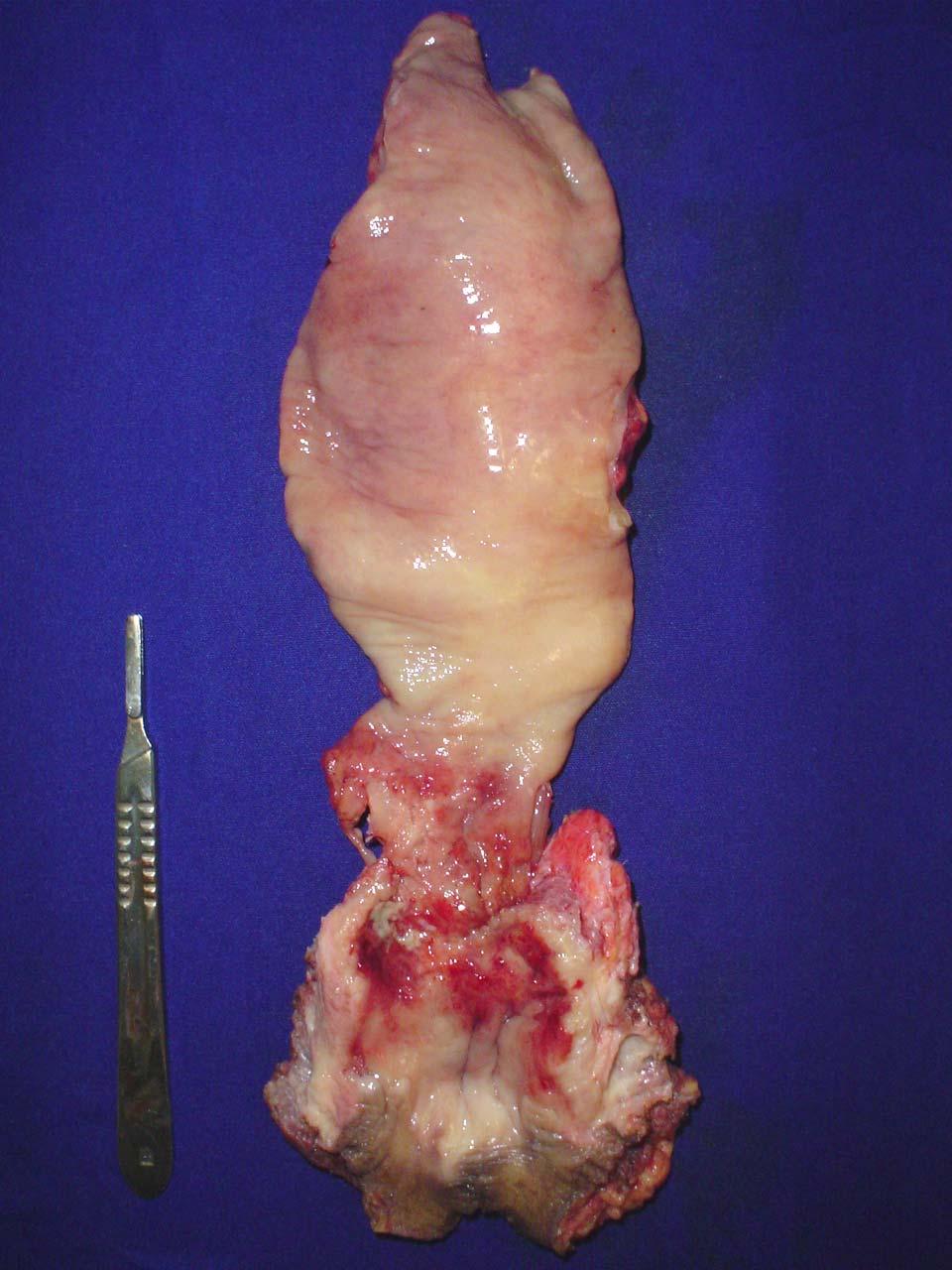 Resultados 23 Bexiga Tumor do reto Figura 5: Amputação abdominoperineal do reto e cistectomia total Essa figura mostrou um tumor de