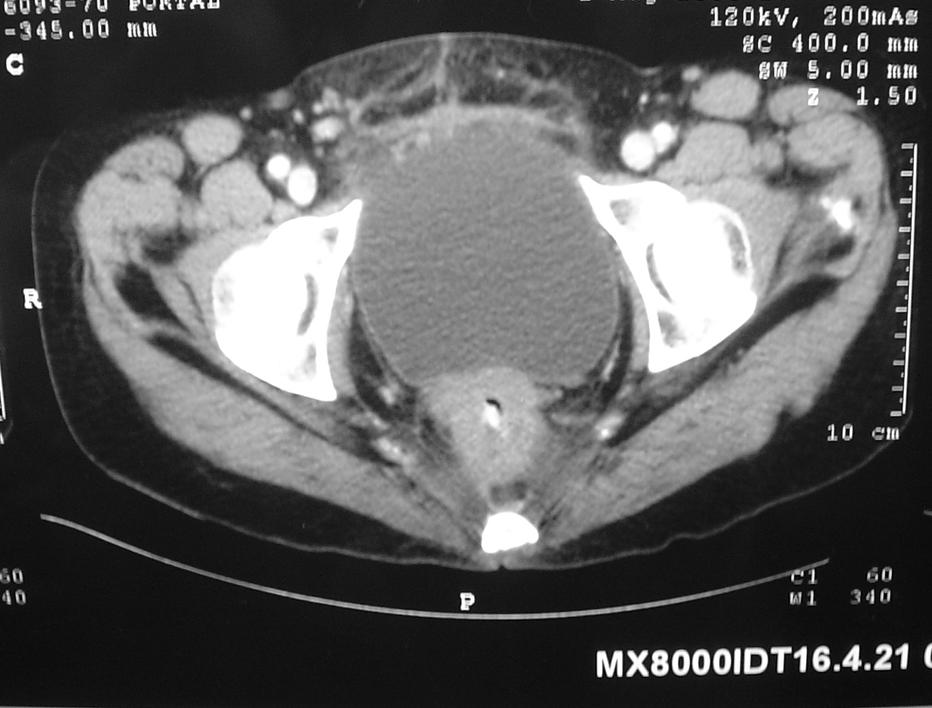 Resultados 25 Na Figura 8 temos o resultado de um exame de imagem, no caso uma tomografia computadorizada da pelve, que permite avaliar no pré-operatório, a invasão do tumor do reto em direção à