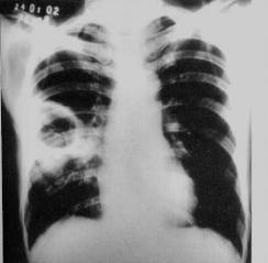 10. Homem, 26 anos, usuário de drogas injetáveis há 6 meses, é admitido na emergência com quadro de febre alta diária (39 a 40 o C), dispneia, perda de peso, inapetência, cefaleia e adinamia há 1