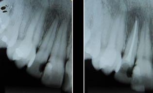 Em caso de lesão periapical associada ao dente tratado, deverá