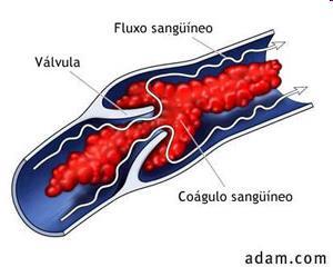 Hiperemia Passiva Classificação Congestão