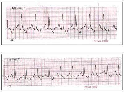 LOCAL: Nódulo sinusal Taquicardia Sinusal ARRITMIAS ATRIAIS Comando sinusal com aumento da FC. Padrão de ondas (P-QRS-T) mantido.