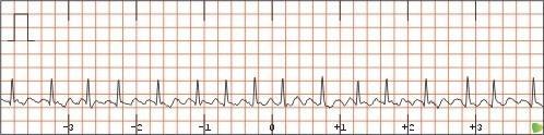 LOCAL: Músculo Atrial Flutter Atrial ARRITMIAS ATRIAIS Um foco ectópico no átrio comanda o ritmo numa frequência elevada.