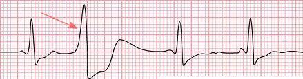 ARRITMIAS VENTRICULARES LOCAL: Músculo ventricular Extra-sístole ventricular Um foco ectópico dentro do ventrículo estimula a contração.