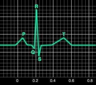 TRAÇADO ECG NORMAL ELETROCARDIOGRAFIA Ondas P- QRS -T Onda P Representa a sístole atrial (despolarização dos átrios);