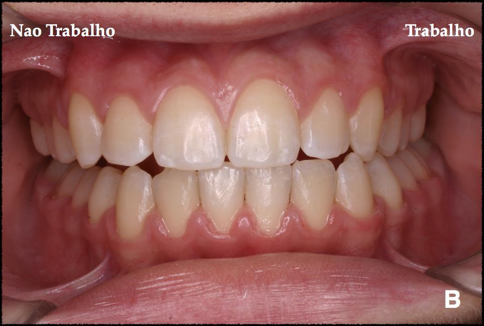 30 Figura 12: Movimento de lateralidade para a esquerda Durante o movimento do lado de trabalho, o côndilo faz rotação e translação sobre as paredes posterior e superior da fossa mandibular do osso