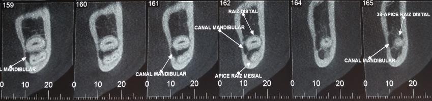 37 Figura 15 Relação entre as raízes do dente 38 e o canal mandibular.