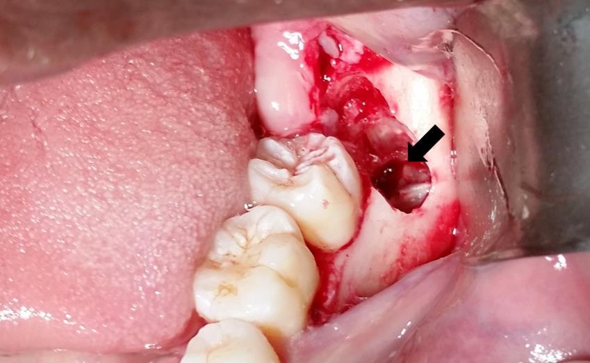 40 Três odontossecções foram necessárias para remover a coroa de forma cuidadosa e evitar a mobilização das raízes do remanescente dentário, ilustrado na figura 20.