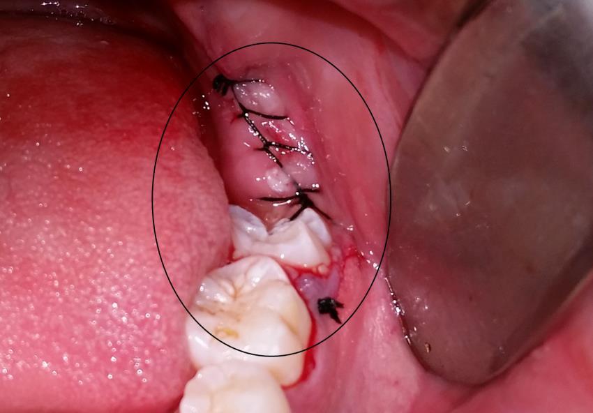 41 Figura 21 Vista da região após a sutura. Não houve intercorrências durante a cirurgia. Foram adotados os cuidados pós-operatórios com controle de dieta, prescrição medicamentosa e fisioterapia.