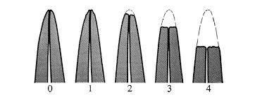 0 = Sem reabsorção radicular (figura 2). 1= Reabsorção mínima: Contorno radicular irregular (figura 3).