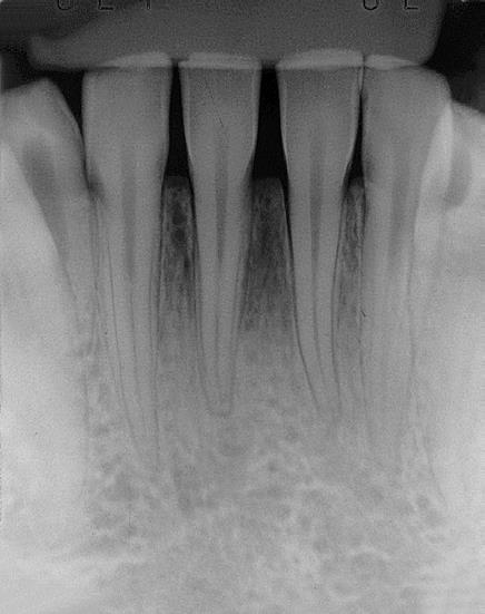 , 1982, utilizada para avaliar o grau de reabsorção radicular, Quando, no exame radiográfico, se evidencia uma reabsorção mínima ou ausência de