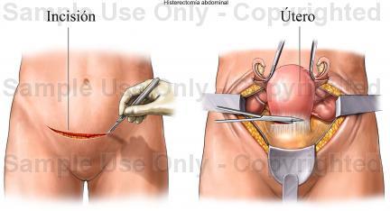 Histerectomia: Roturas extensas ou hemorragias rebeldes