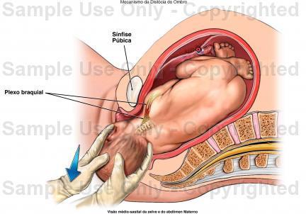 Distócia de ombros É quando no parto vaginal ou mesmo na cesárea, ocorre o desprendimento da cabeça fetal e uma impactação do ombro anterior na sínfise púbica.