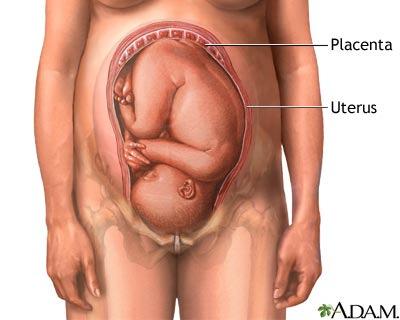 Placenta prévia Consiste na implantação da placenta no