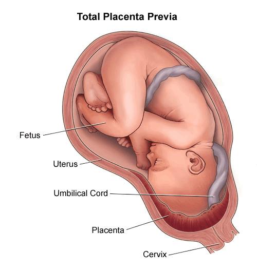 Classificação Completa ou total: a placenta