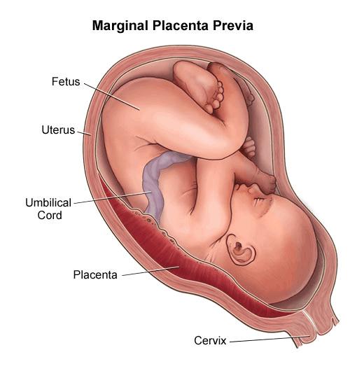 Marginal: a placenta atinge a