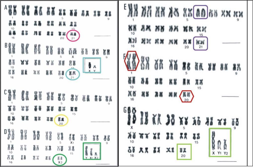 Figura 2. Cariótipos dos citótipos de Hoplias malabaricus com coloração convencional. Citótipos A, B, C, D, E, F e G. (Fonte: Bertollo et al., 2000). Barra = 5μm.