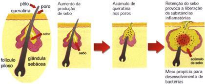 A acne é um problema que afeta grande parte da população brasileira. Os chamados cravos (comedões) e espinhas (acne) incomodam adolescentes, adultos, homens e mulheres.