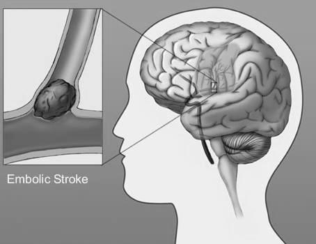 ) Freqüência relativa (%) Criptogenético 30 Causas pouco freqüêntes (Estados pró-trombóticos, Dissecção artérias cranianas, arterites,, vasoespasmo,