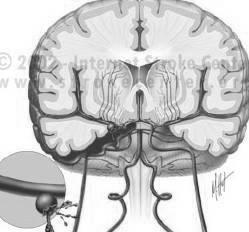 e 50% apresentam seqüelas graves Nos que chegam ao hospital, 40% morrem na primeira semana. 1. Ruptura de aneurismas saculares (dois terços dos casos). 2. Ruptura de malformações arteriovenosas 3.