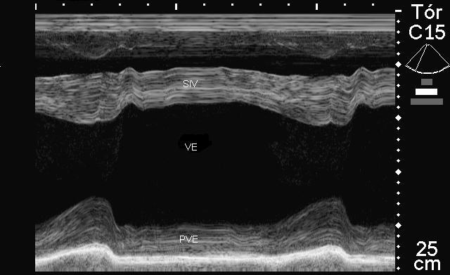 45 Figura 1 Imagem ecocardiográfica obtida pela janela paraesternal direita, em Modo M do ventrículo