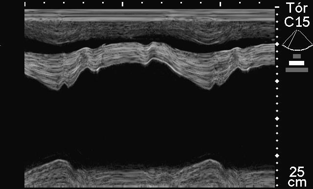46 Figura 3 Imagem ecocardiográfica obtida pela janela paraesternal direita, em Modo M do ventrículo esquerdo, de um equino do grupo PSI.