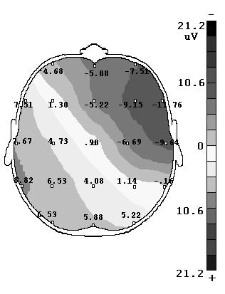 do tempo 5 quer em forma de mapa a actividade medida é interpolada para diferentes pontos da cabeça e visualizada num mapa cerebral bi-dimensional (fig. 5.10). Figura 5.