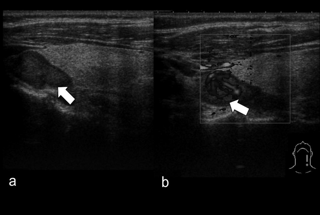 Fig. 3 - Adenoma da glândula paratiróide superior esquerda: Ecografia parassagital (a) com adição de power-doppler (b) efectuada a mulher de 50 anos com hiperparatiroidismo.