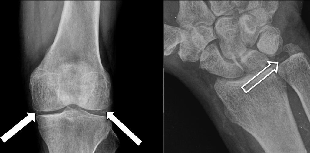 padrão em Rugger-Jersey. As alterações osteoscleróticas são mais comuns no hiperparatiroidismo secundário. Fig.