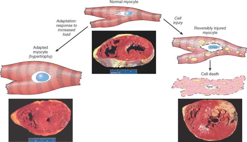 Alterações no Miocárdio 10 Hipertrofia Cardíaca 11 Hiperplasia Aumento da quantidade (número) de células aumento da massa de um órgão ou tecido Hiperplasia Fisiológica Hiperplasia hormonal aumenta a