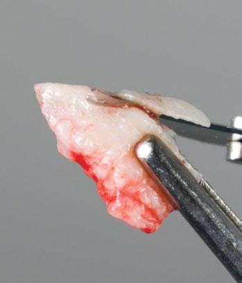 para aumento de tecido queratinizado cuidados no manejo protético de casos tardios opções de tratamento para casos desfavoráveis: explantação e próteses dentogengivais técnicas convencionais e