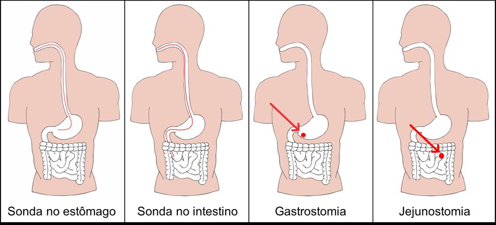 6. Vias de administração da alimentação enteral Sonda no estômago: a sonda é passada pela boca (orogástrica) ou pelo nariz (nasogástrica) até o estômago.