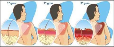 QUEIMADURA É a lesão tecidual decorrente da ação direta ou indireta do calor, podendo resultar de diferentes fontes (líquido quente, fogo, objetos aquecidos, eletricidade,