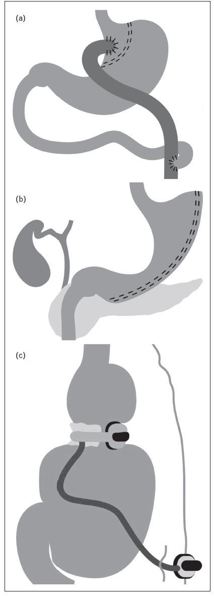 A revisão de Malkani (2013) aponta que a rápida perda de peso e a melhora nos marcadores metabólicos no pós-cirúrgico ocorrem não apenas devido a má-absorção intestinal, mas à baixa ingesta calórica