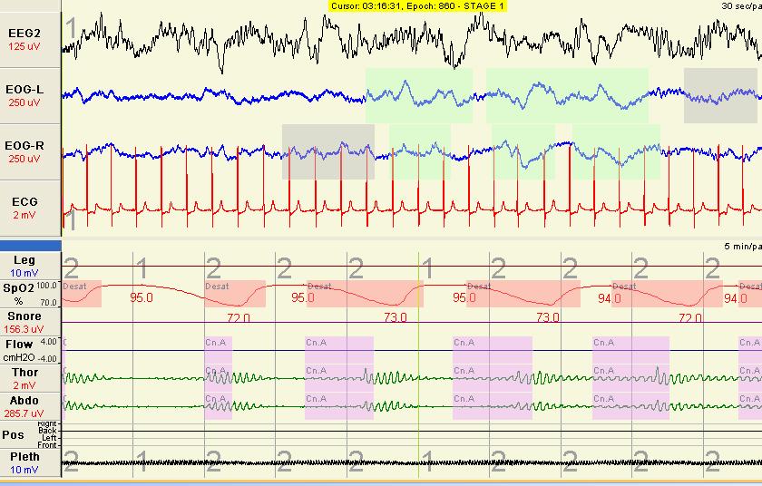 RITMO RESPIRATÓRIO Ritmo de Cheyne-Stokes Taquipnéia/apnéia Respiração superficial, rápida e profunda de 30 a 170 segundos pontuados por períodos de apnéia durando 20 a 60 segundos.