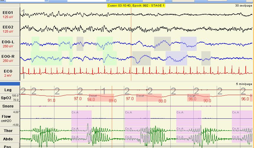 RÍTMO RESPIRATÓRIO Ritmo de Cheyne-Stokes RÍTMO RESPIRATÓRIO Ritmo de Kussmaul Respiração rápida (acima de 20 irpm), profunda