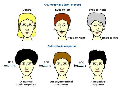 MOVIMENTOS OCULARES ESPONTÂNEOS Movimentos errantes Desvio conjugado dos olhos para cima