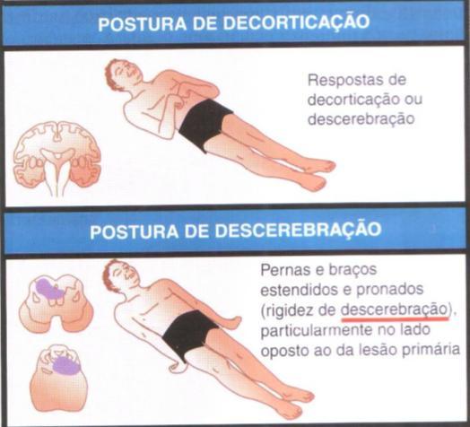 Localização supratentorial - disfunção hemisférica focal 2.