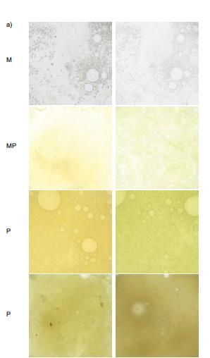 Cor da secreção e carga bacteriana M < MP < P = Carga Bacteriana Sputum colour: a useful clinical