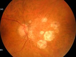 G retinografia Veias retinianas dilatadas e tortuosas. H, I e J Hiperfluorescência das paredes vasculares. J OROIT SRPIGINOS fecção progressiva, crónica, bilateral afectando o PR e a coróide.