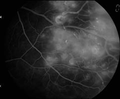 Temporalmente ao granuloma, na média periferia, evidência de colaterais e telangiectasias, acompanhadas por áreas de má perfusão capilar retiniana.