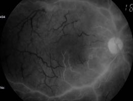 G H ig. 9.4 Necrose retiniana aguda.